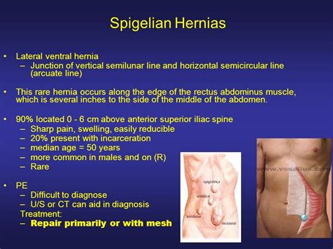 femoral hernia pronunciation.